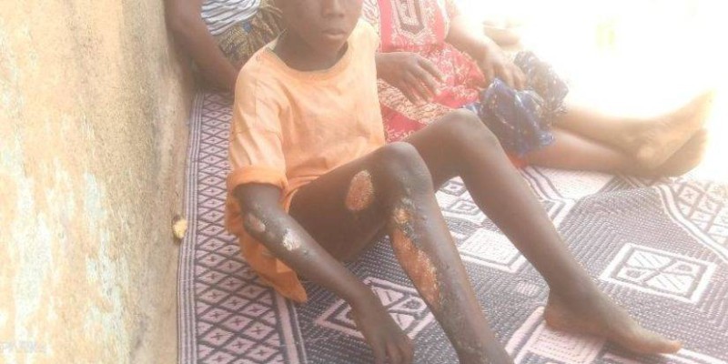 L'adolescent brûlé dans l'incendie du champ de son oncle à Mankono. (DR)