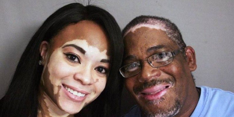 Des personnes atteintes du vitiligo. (DR)
