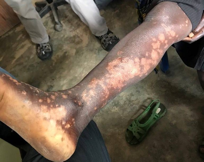 leprosy_2_