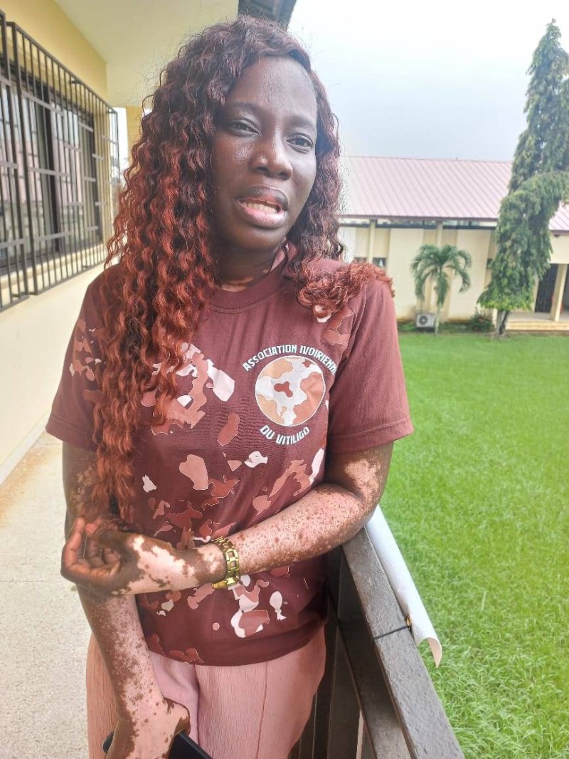 N’dri Amoin Marcelline a contracté cette pathologie à l’âge de 30 ans. (Ph:PN)
