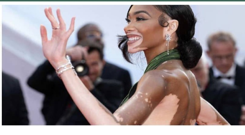 Une star atteinte du vitiligo.