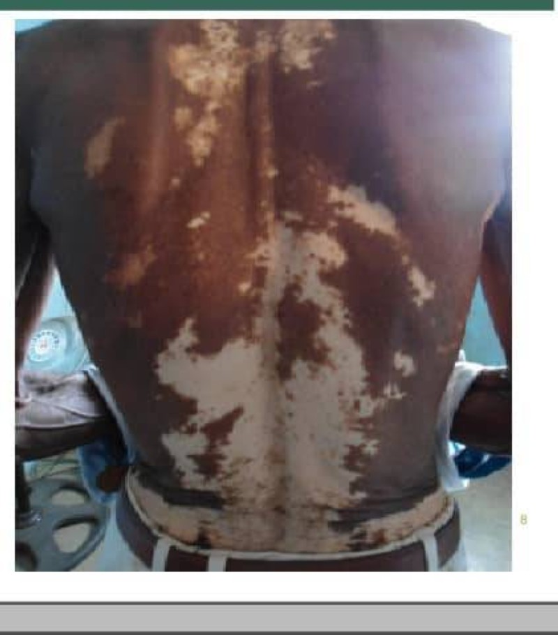 Une peau  atteinte du vitiligo.