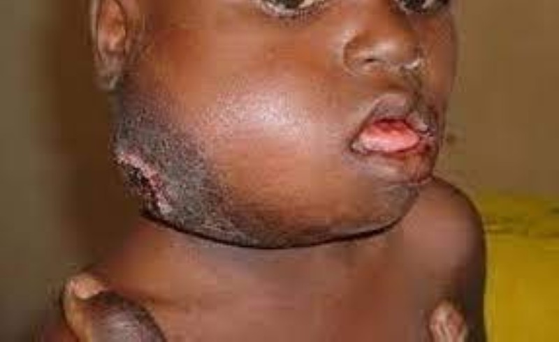 Le cancer chez un enfant tue en 6 mois si le patient ne reçoit pas de soin (DR)