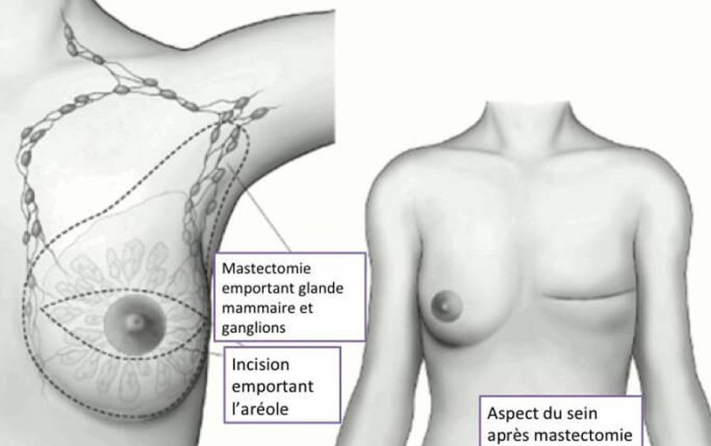 La chirurgie reconductrice du sein zprès ablation