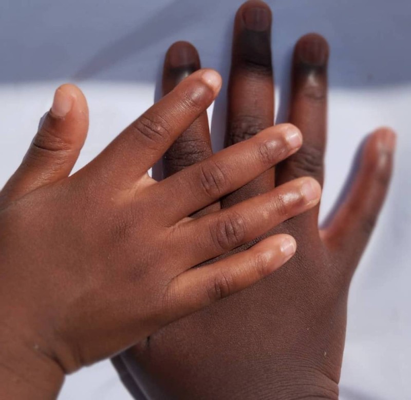 Dépigmentation en Côte d'Ivoire