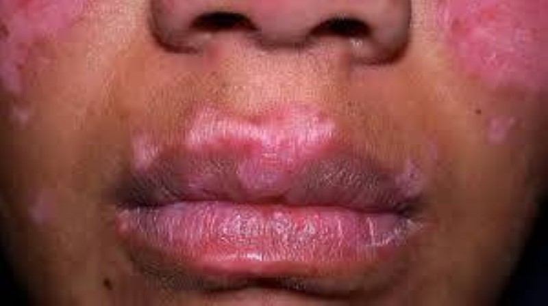 Un patient du Lupus. (Ph: Dr)