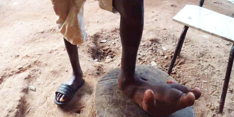 Une vue du pied malade de Mohamed Camara. (Ph: Dr)