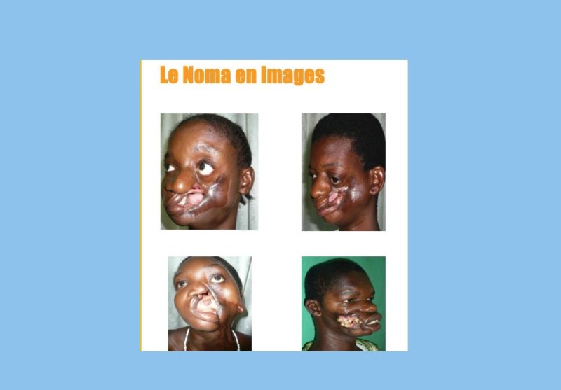Noma3