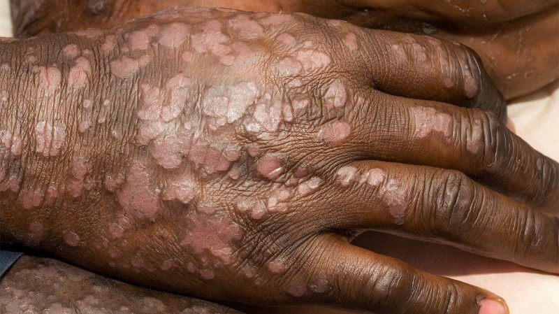 Chaque patient a "son" psoriasis, différent de celui de son voisin; un traitement qui agit pour l'un, n'agira pas forcément pour l'autre. (Ph:DR)