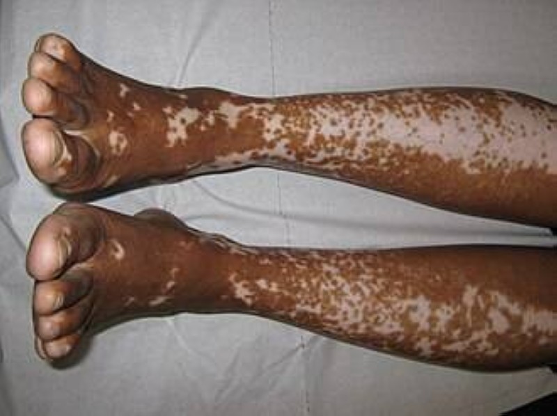 Le Vitiligo. (Ph:Dr)