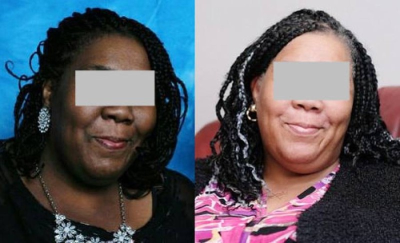 Une dépigmentation nossive (Dr)